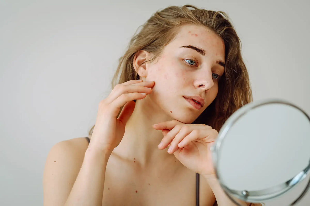 Cum îți construiești o rutină K-beauty dacă ai ten sensibil și acnee în același timp